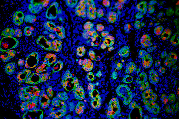 acinar-to-ductal metaplasia (ADM)