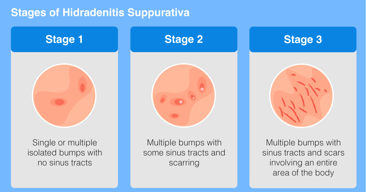 stages-of-hidradenitis-suppurativa.jpg