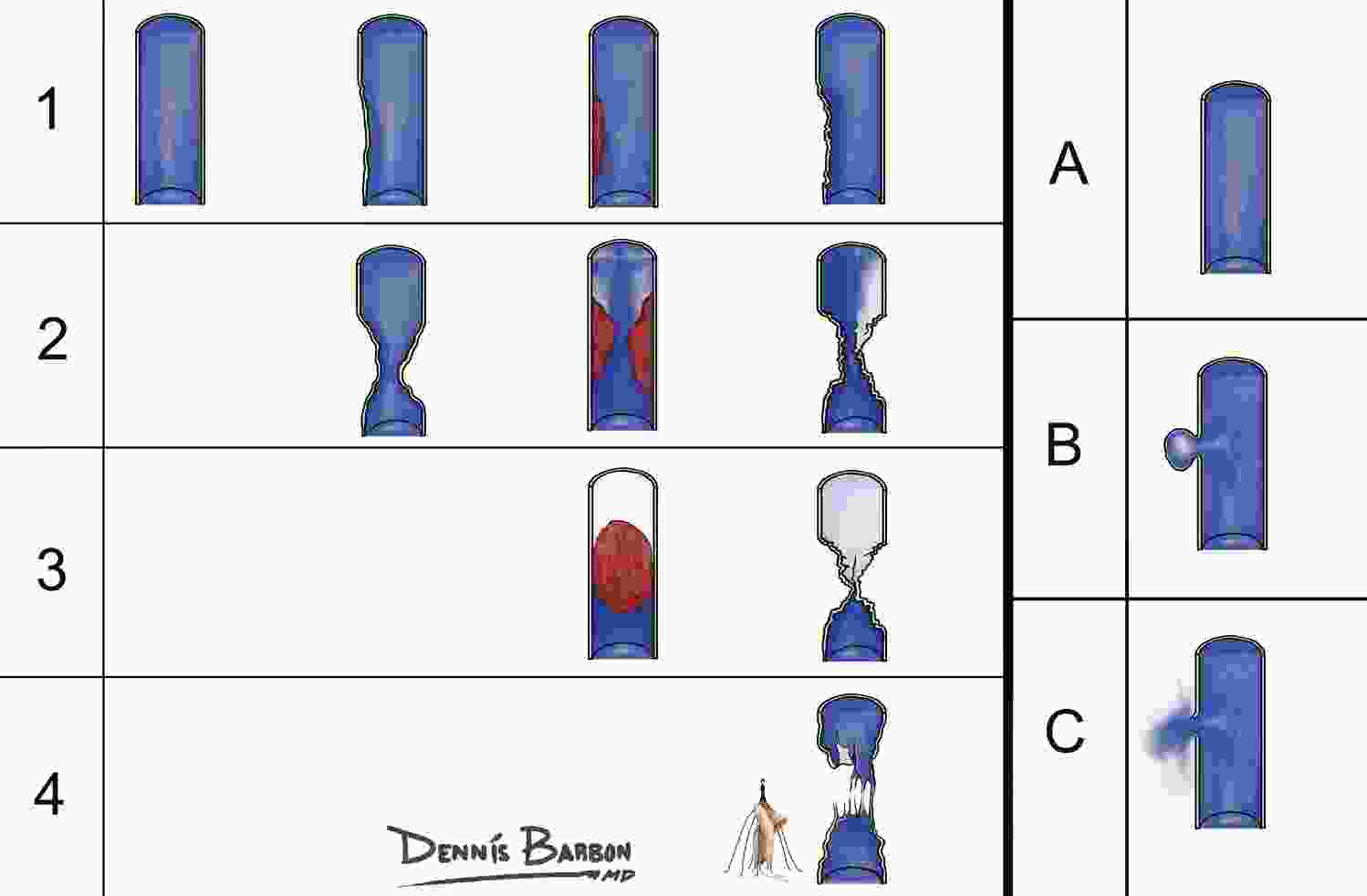 IVC Injury Classification System