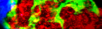 Tumor growth & metastasis_tile.jpg